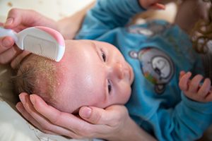 La crosta lattea del neonato: cause, rimedi e consigli
