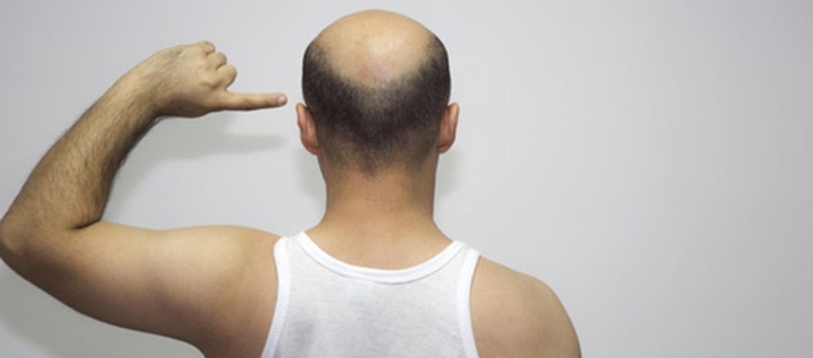 alopecia-0