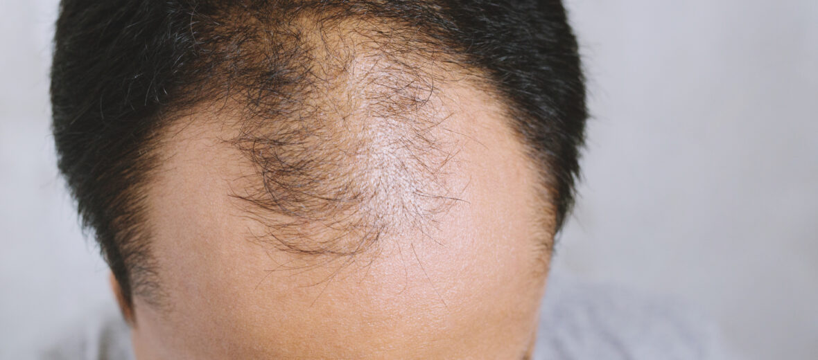 I benefici della Laser Terapia