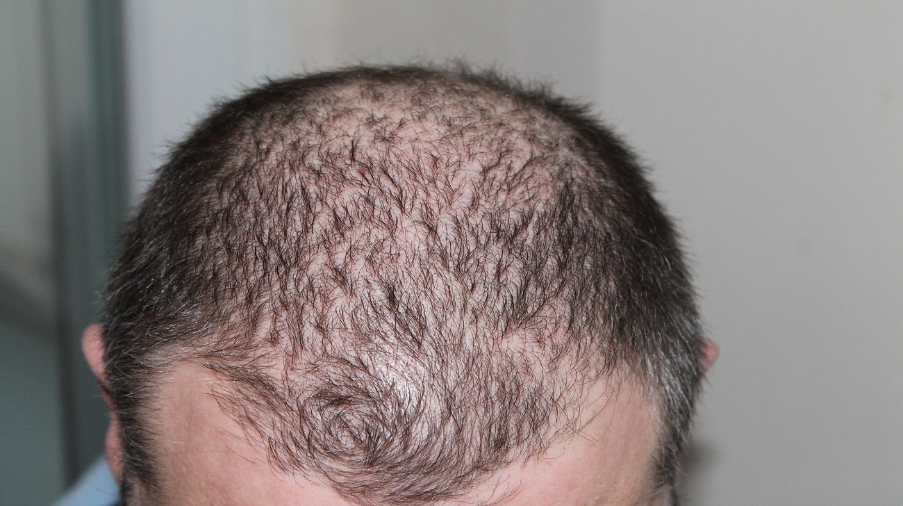 trattamenti per la caduta dei capelli
